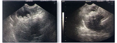 プラセンタによる肝機能改善例